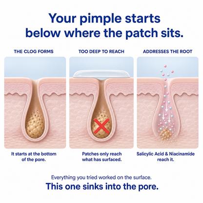 Overnight Acne Buster